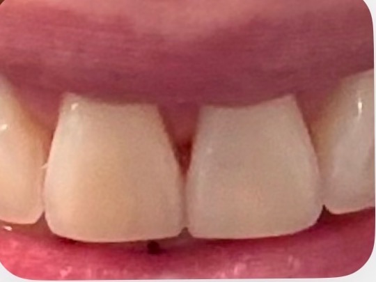 Lesly's teeth after the 7-day Luxissimo protocol