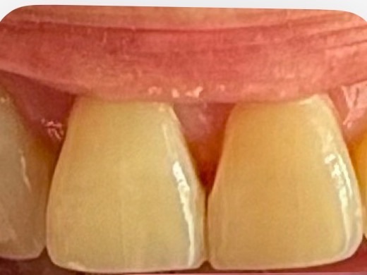 Lesly's teeth before the 7-day Luxissimo protocol